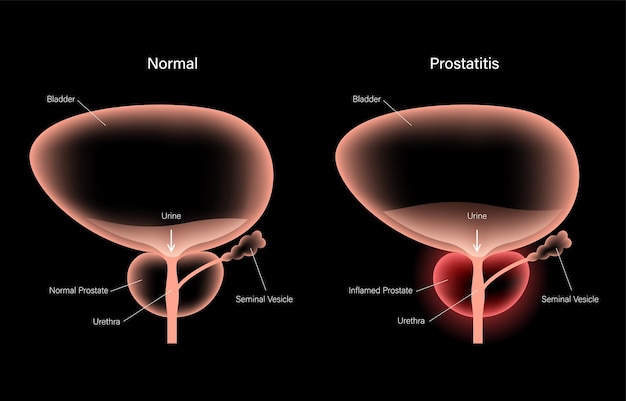 Problème D'inflammation De La Prostatite