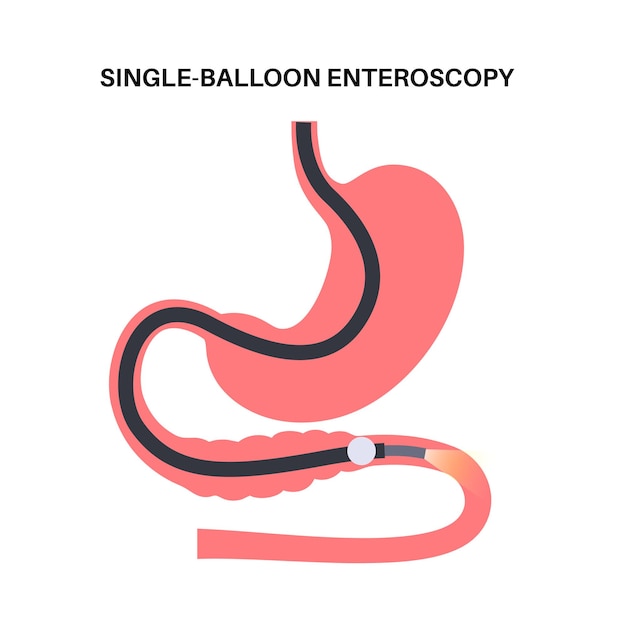 Vecteur procédure d'entéroscopie à ballonnet unique visualisation de la technique non chirurgicale de l'intestin grêle problème du tractus gastro-intestinal biopsie élimination des polypes thérapie hémorragique ou vecteur plat de placement de stent