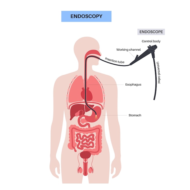 Procédure de gastroscopie Le gastro-entérologue utilise un gastroscope Diagnostic de l'estomac et de l'intestin Endoscopie gastro-entérologique et maladie gastro-intestinale Problème du système digestif et vecteur de traitement