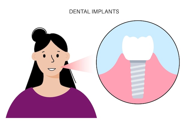 Vecteur procédure d'implant dentaire