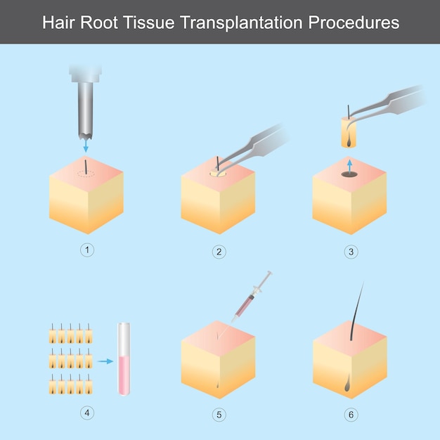 Vecteur procédures de greffe de tissu de racine de cheveux. illustration montrant les étapes techniques des procédures de transplantation de tissus de racine de cheveux