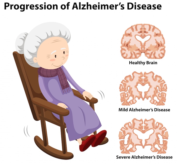 Vecteur progression de la maladie d&#39;alzheimer
