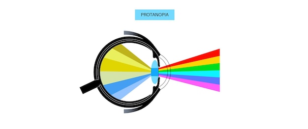 Vecteur protanomalie et protanopie