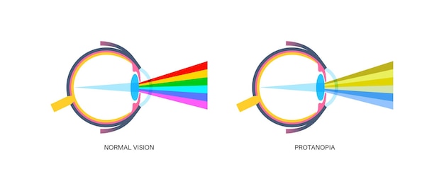 Vecteur protanomalie et protanopie