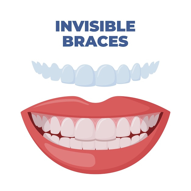 Protecteur buccal Dents avec appareils orthodontiques transparents Alignement des dents par des aligners Formateur orthodontique