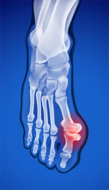 Radiographie du pied avec un os anormal dans l'articulation du pouce qui provoque une douleur intense
