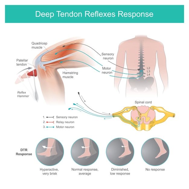 Vecteur réponse aux réflexes profonds du tendon le médecin teste les systèmes nerveux à l'aide d'un marteau réflexe en frappant sur le tendon dans la région du genou, ce qui provoque le mouvement automatique du tibiaxa
