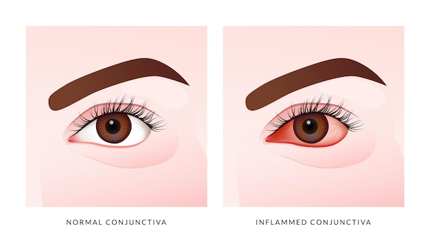 Rougeur Symptôme oculaire Symptômes d'uvéite ou inflammation oculaire