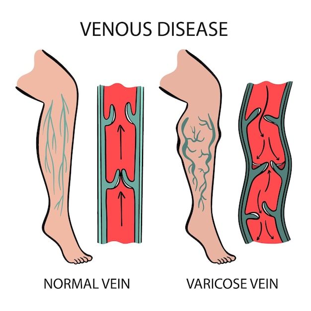 Vecteur schema des maladies veineuses varices de la médecine humaine