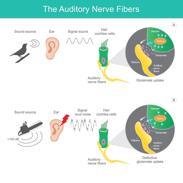 Vecteur la source sonore de comparaison des fibres nerveuses auditives 2 types auxquels il est envoyé le signal sonore aux fibres nerveuses auditives affectant le cerveau humainxa