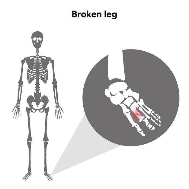 Vecteur squelette de jambe cassée zoom