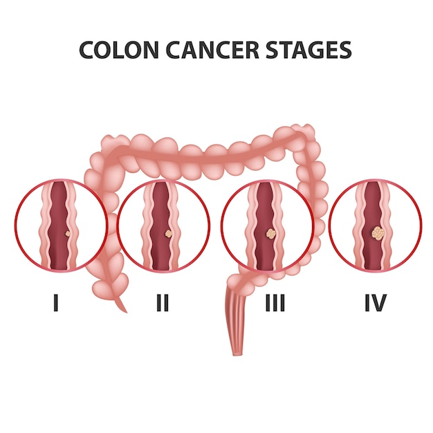 Stade Du Cancer Du Côlon Illustration Vectorielle Médicale