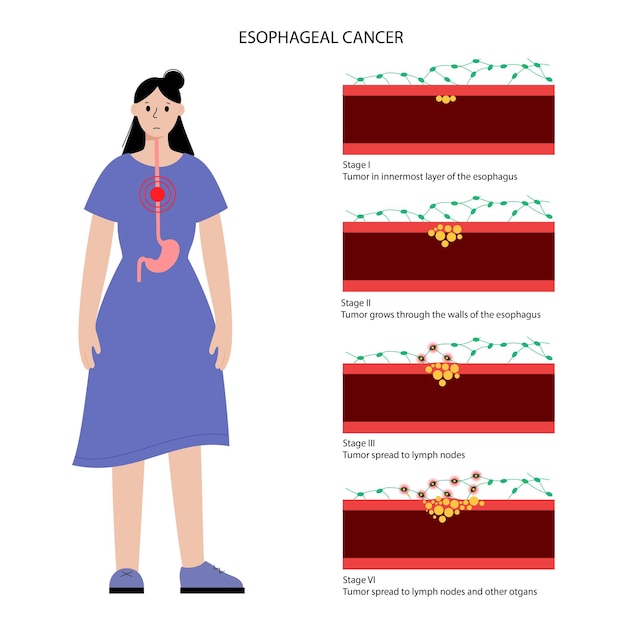 Vecteur stades du cancer de l'œsophage