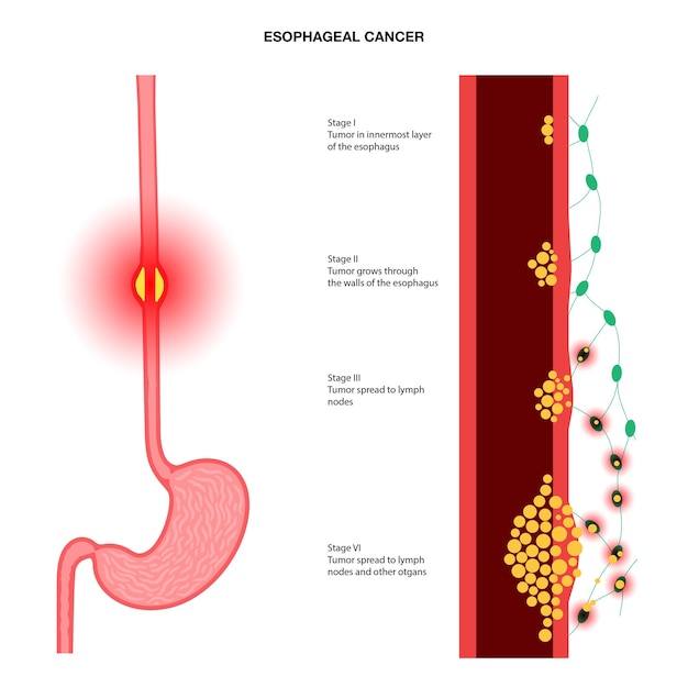 Vecteur stades du cancer de l'œsophage