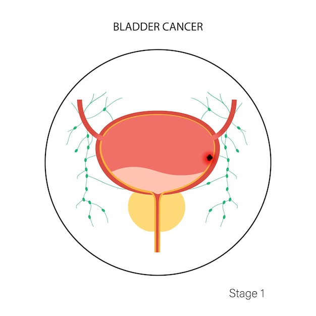 Stades Du Cancer De La Vessie