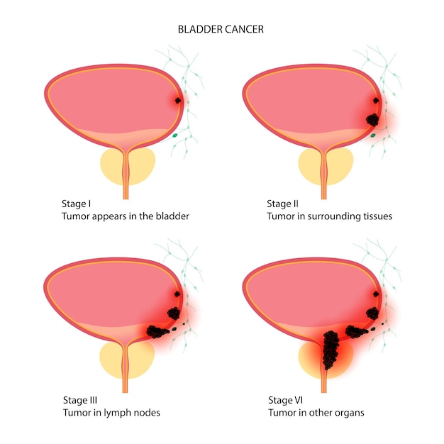 Stades Du Cancer De La Vessie