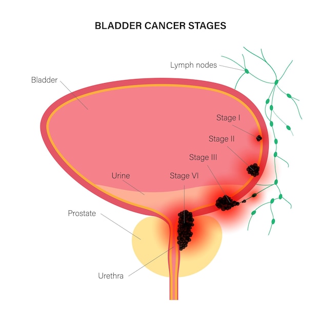 Stades Du Cancer De La Vessie