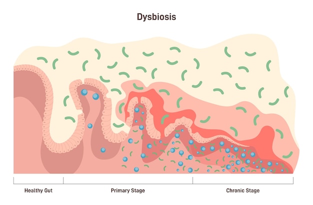 Vecteur stades de dysbiose ou de dysbactériose déséquilibre de la maladie intestinale