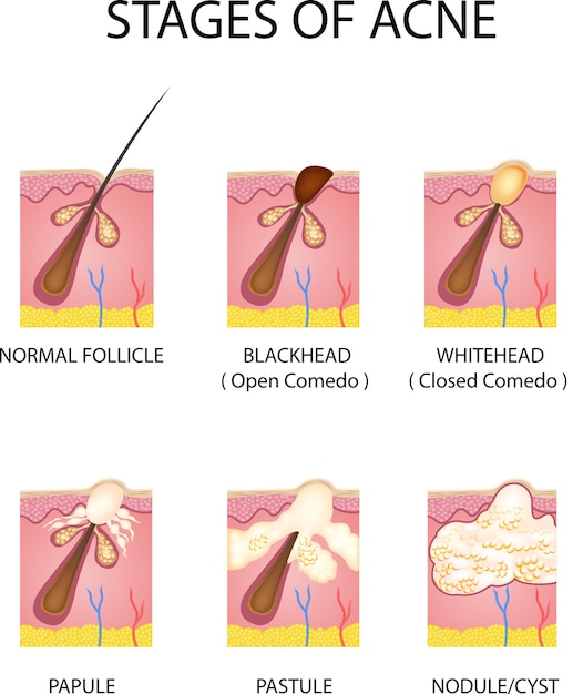 Vecteur stades de la formation de l'acné dans la peau humaine