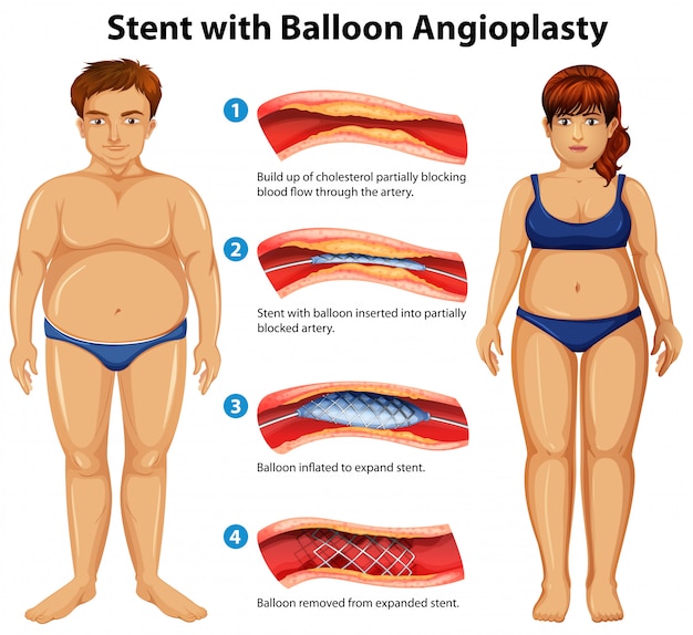 Stent Avec Angioplastie Par Ballonnet