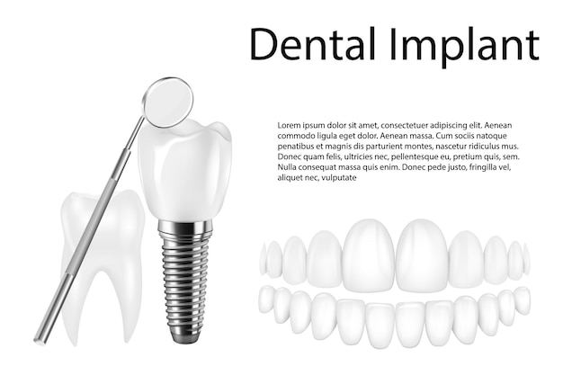 Structure de l'implant dentaire affiche informatique pédagogique picturale médicale avec remplacement molar de l'extrémité d'outils sains modèles d'illustration vectorielle