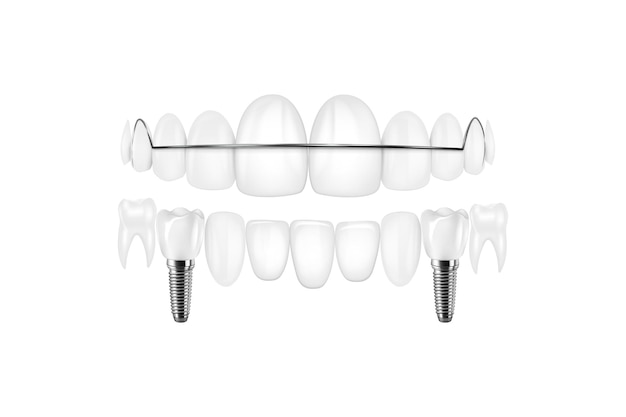 Structure de l'implant dentaire affiche informatique pédagogique picturale médicale avec remplacement molar de l'extrémité d'outils sains modèles d'illustration vectorielle