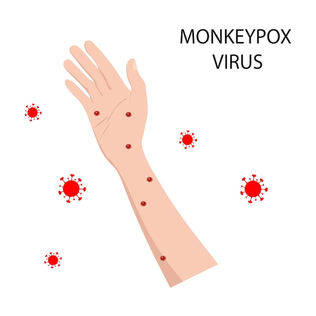 Symptôme de la variole du singe sur le corps humain Illustration vectorielle de la variole du singe