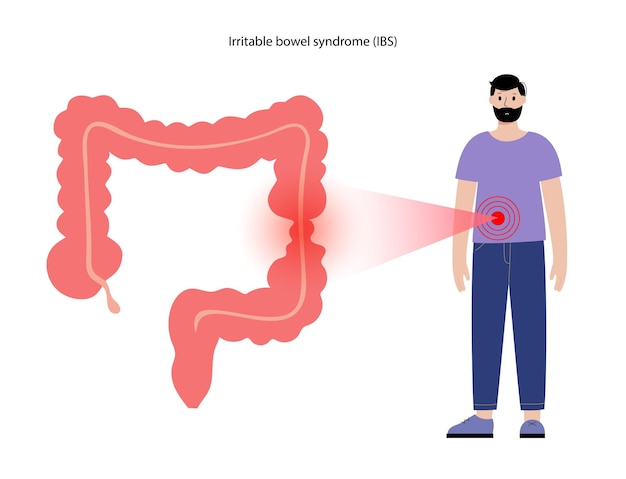 Syndrome Du Côlon Irritable