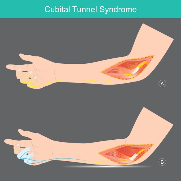 Vecteur syndrome du tunnel cubital une condition qui implique une pression ou un étirement du nerf cubital dans les bras qui peut provoquer un engourdissement ou des picotements dans l'anneau et les petits doigtsxa