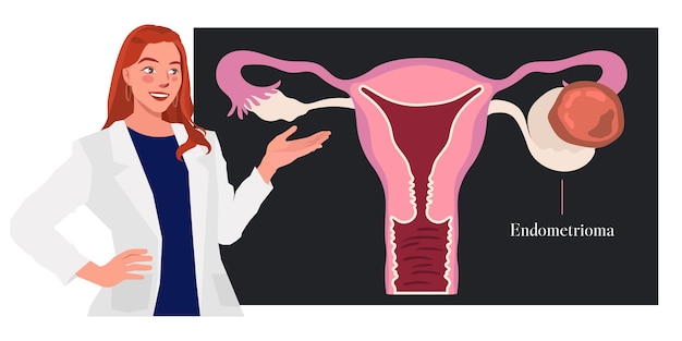 système reproducteur féminin kyste ovarien obgyn expliquer l'illustration