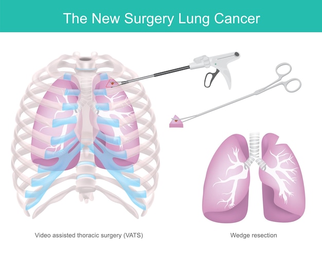 Vecteur technique chirurgicale pour le cancer du poumon technique chirurgicale enlevant une partie du poumon en raison d'un cancer