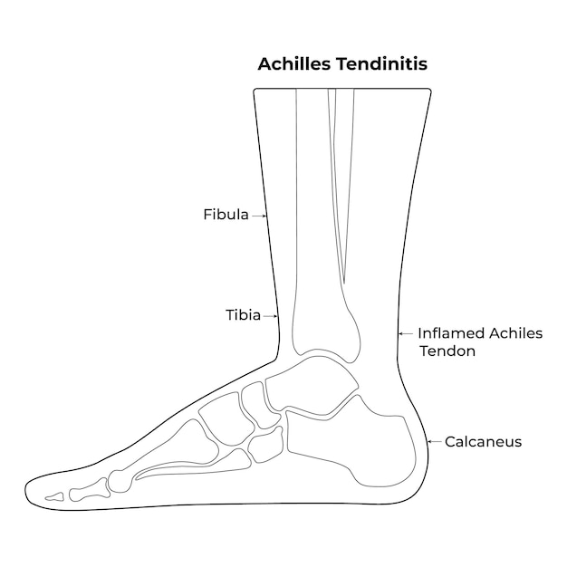 Vecteur tendinite d'achille fibule du tibia inflammation du tendon d'achille calcaneus illustration vectorielle de l'os de la jambe