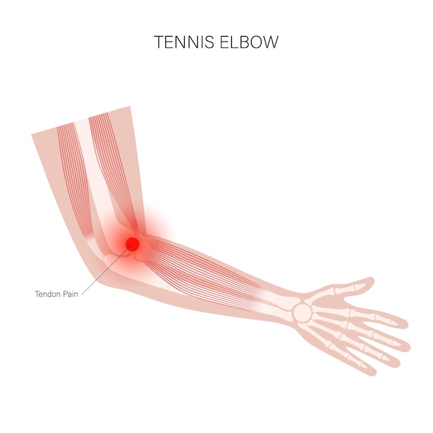 Tennis Elbow épicondylite Latérale