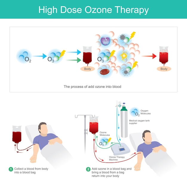 Vecteur thérapie à l'ozone à haute dose ce processus ajoute de l'ozone dans une poche de sang et ramène le sang d'une poche dans votre corpsxa