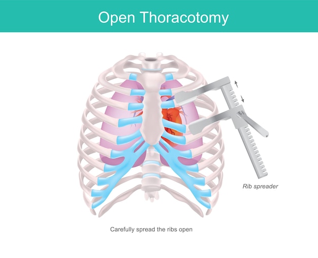 Vecteur thoracotomie ouverte procédure permettant d'accéder à l'espace pleural de la poitrine humaine par un médecin