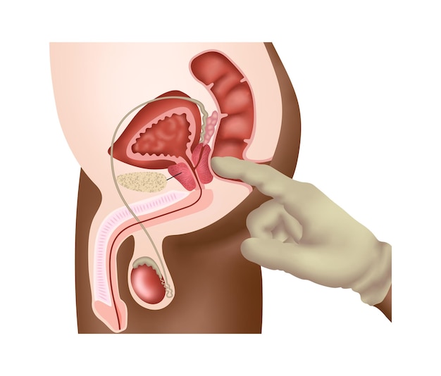 Vecteur toucher rectal numérique pour la prostate