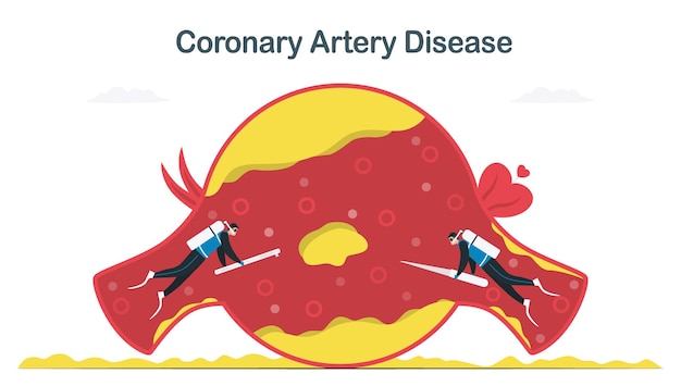Traitement De La Maladie Coronarienne Causée Par L'athérosclérose. Plus De Cholestérol Et De Dépôts Graisseux Dans Les Vaisseaux Sanguins. Illustration Vectorielle De Cardiologie Isolée Sur Fond Blanc.