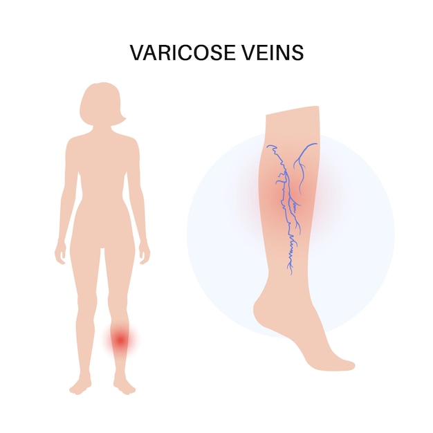 Vecteur traitement des varices