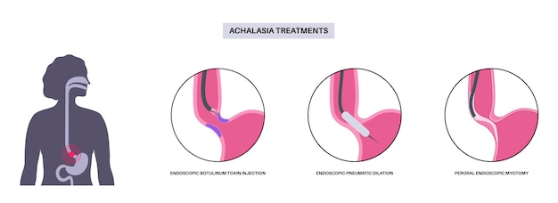 Traitements De L'achalasie Procédures Mini-invasives Sphincter œsophagien Inférieur Fermé Injection Endoscopique De Toxine Botulique Dilatation Pneumatique Et Poem Trouble De L'illustration Vectorielle De L'œsophage