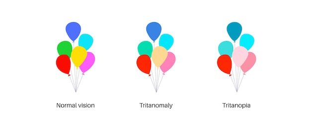 Vecteur tritanopie et tritanomalie