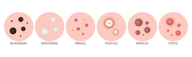 Types D'acné Acné Sur La Peau Et Comédons Sur Le Visage Icônes Vectorielles De L'acné Sur La Peau