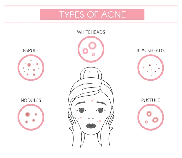 Vecteur types d'acné, nodules de boutons, papule, points blancs, points noirs, pustule.