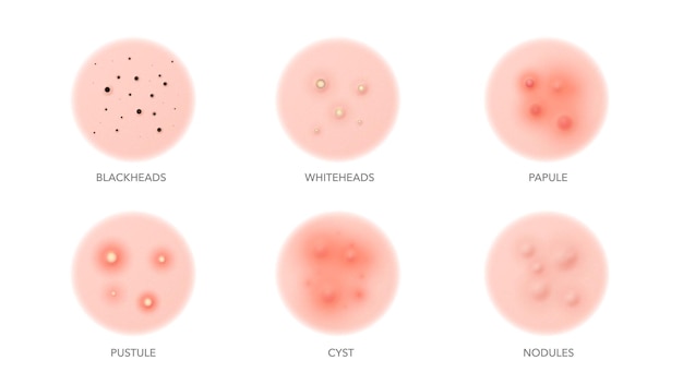 Types D'acné Peau Du Corps Ou Du Visage Boutons Inflammation