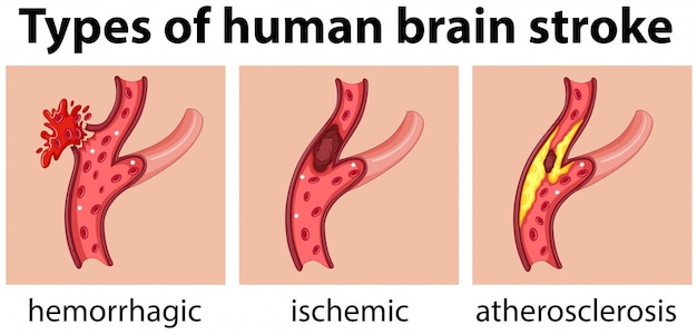 Vecteur types de coup de cerveau humain