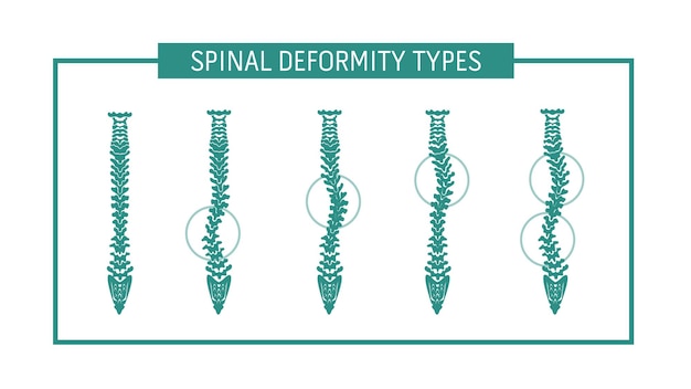 Vecteur types de déformation vertébrale
