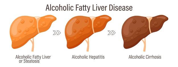 Types De Stéatite Hépatique Maladies Hépatiques Humaines Maladie Hépatique Adipeuse Alcoolique Hépatite