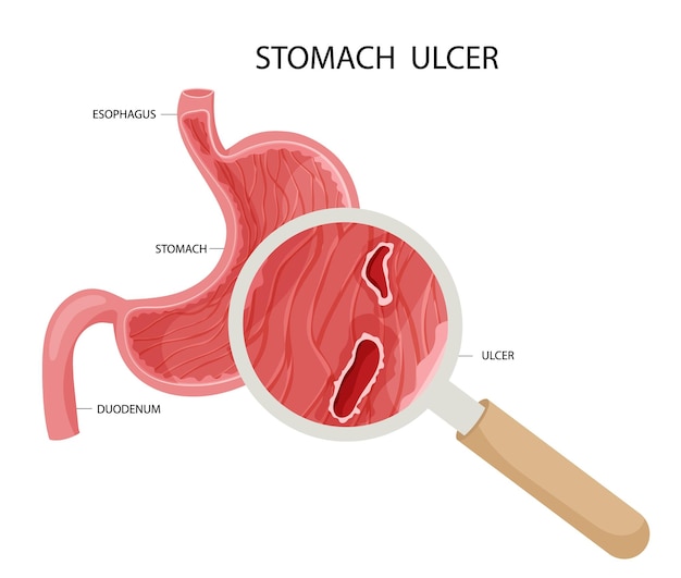 Vecteur ulcère peptique à l'estomac sous grossissement