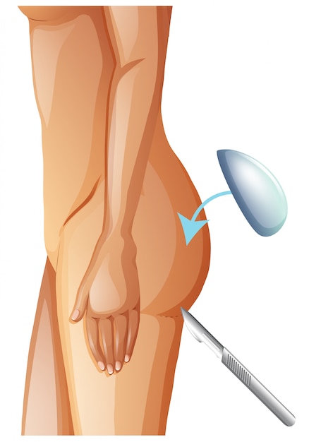 Un Vecteur D'augmentation Des Fesses