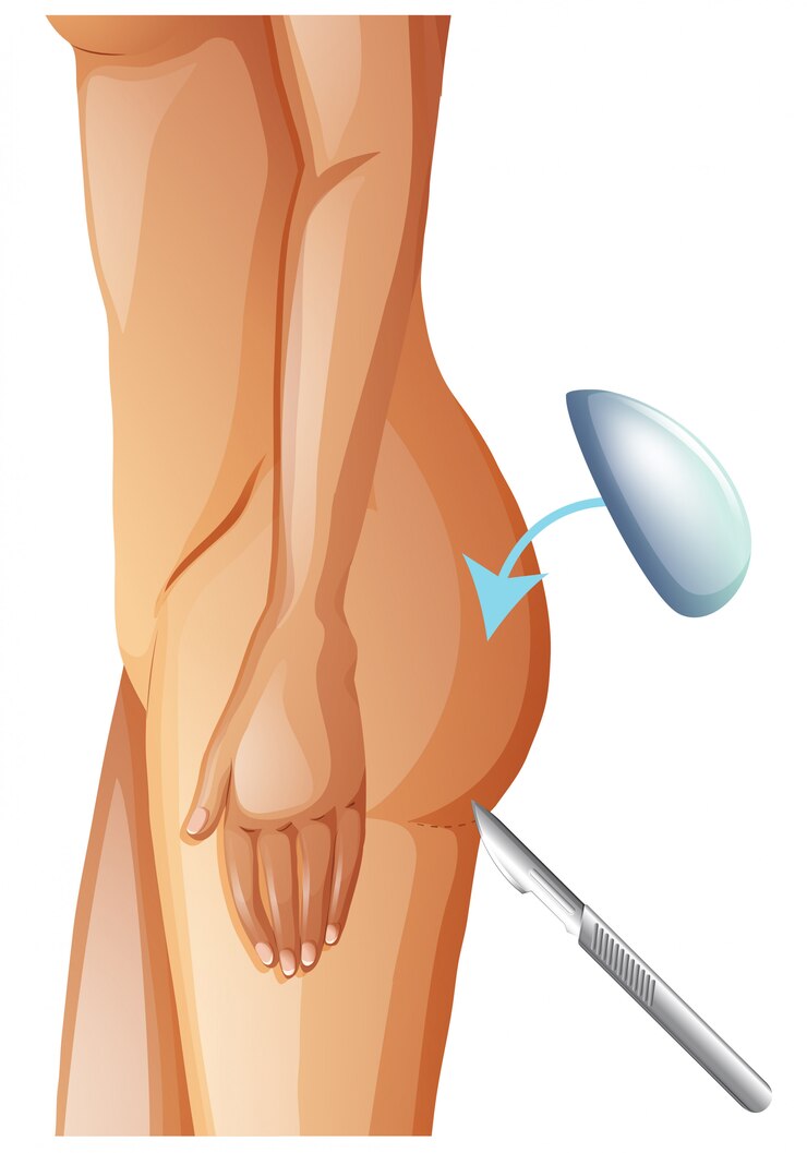 Vecteur un vecteur d&#39;augmentation des fesses