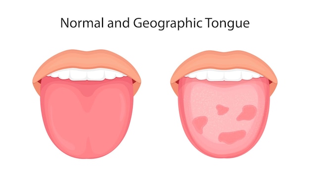 Vecteur De Concept D'organes De La Maladie De La Langue